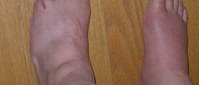 Gout: Causes And Prevention