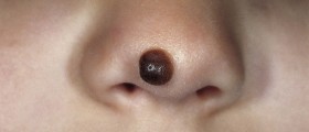 Most Common Types Of Birthmarks And Their Danger Levels