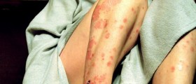 The Most Common Autoimmune Diseases