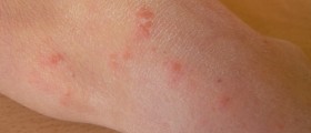 The Complete Guide For Getting Rid Of Scabies