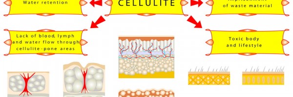The Most Common Causes Of Annoying Cellulite