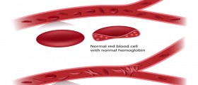 Hidden Dangers Of Sickle Cell Anemia