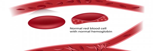 Hidden Dangers Of Sickle Cell Anemia