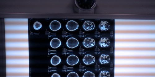 Fahr's Syndrome Or Brain Stones, A Rare Neurological Disease