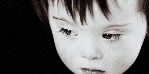 Down's syndrome: What Parents Need to Know