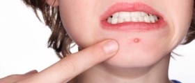 Natural and Home Remedies for Acne (Pimples)