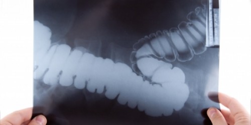 Colorectal  (Colon) Cancer: Causes, Symptoms and Treatment