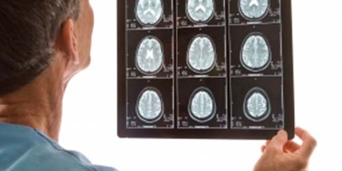 Can MRI Scans Lead to Unnecessary Breast Surgery?