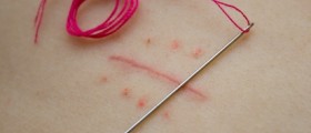 How to Remove Keloid Scars?