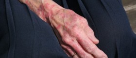 Rare Condition: Leprosy (Hansen's Disease)