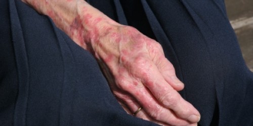Rare Condition: Leprosy (Hansen's Disease)
