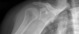 Rotator Cuff Problems: Frozen Shoulder