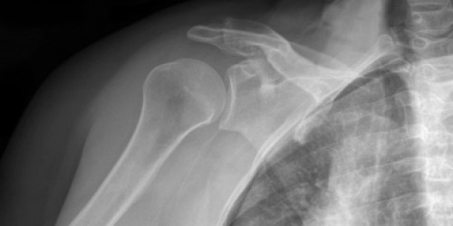 Rotator Cuff Problems: Frozen Shoulder