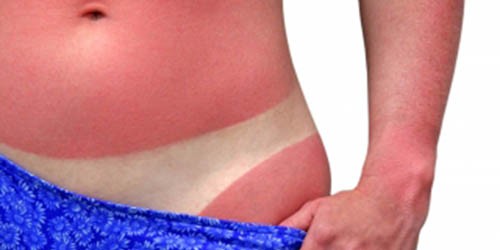 Skin Cancer Melanoma: Symptoms and Treatment Options