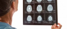 How to Recognize a Stroke?