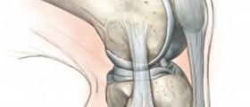 Partial Knee Replacement - Unicompartmental Knee Arthroplasty