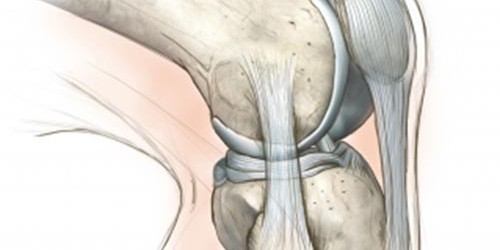 Partial Knee Replacement - Unicompartmental Knee Arthroplasty