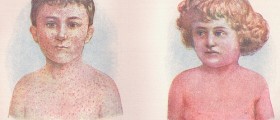 Scarlet Fever in Children