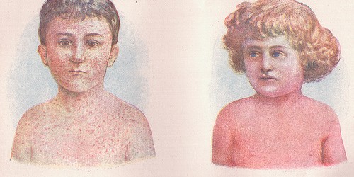 Scarlet Fever in Children