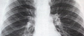 Dangers of Sternum Fracture (Breast Bone)