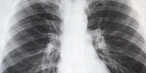 Dangers of Sternum Fracture (Breast Bone)