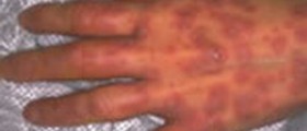 Stevens Johnson syndrome (SJS): Symptoms & Treatment