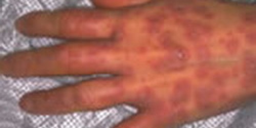 Stevens Johnson syndrome (SJS): Symptoms & Treatment