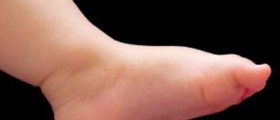 Flat Feet in Children