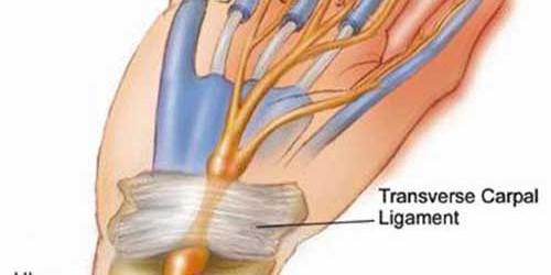 Numb hands relation to Carpal Tunnel Syndrome