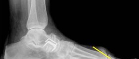 Cheilectomy