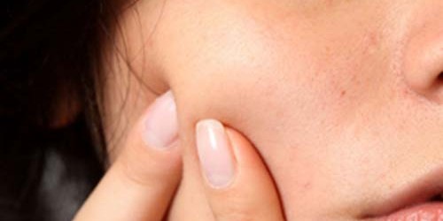 What Acne is and How it Affects the Afflicted