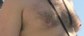 Enlarged Male Breasts: Solution for Gynecomastia