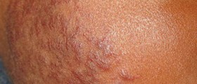 Discoid Lupus Erythematosus: Symptoms and Treatment