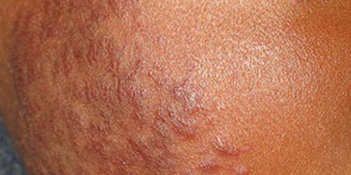 Discoid Lupus Erythematosus: Symptoms and Treatment