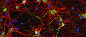 Misconception of Alzheimer's: Genetically Inherited or Not?
