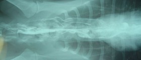 Myasthenia Gravis: Symptoms and Treatment of a Muscular Disorder