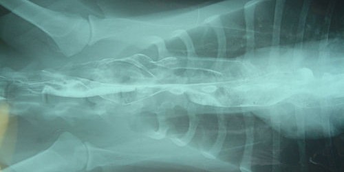 Myasthenia Gravis: Symptoms and Treatment of a Muscular Disorder