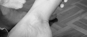 Laser Acupuncture May Help Bedwetters Break Nighttime Habit