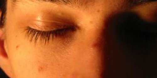 Adult Acne Facts: Causes and Cure