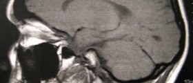 Neurofibromatosis Genetic Disorder: Nerve Tissue, Skin and Bones Abnormalities