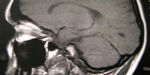 Neurofibromatosis Genetic Disorder: Nerve Tissue, Skin and Bones Abnormalities