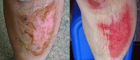 Home Remedies for Skin Burns and Cuts