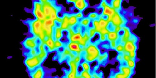 Hydrocephalus: Water on the Brain