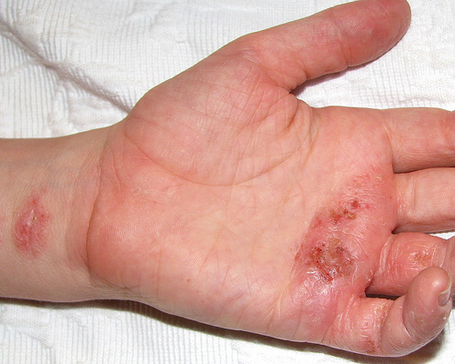 Eczema on the vulva