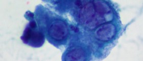 Home Remedies for Genital Herpes
