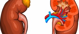 Kidney Problems (Kidney Stones) on a Rise Among Kids