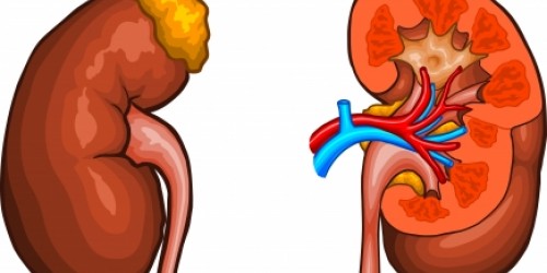 Kidney Problems (Kidney Stones) on a Rise Among Kids