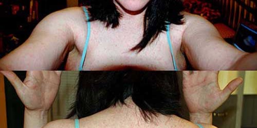 Low Sun Exposure And The Multiple Sclerosis