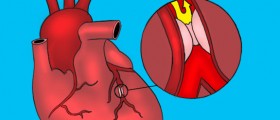 Stents Or Bypass: Which Is Safer For Diabetics?