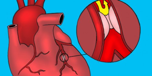 Stents Or Bypass: Which Is Safer For Diabetics?